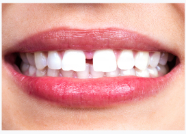 Teeth Gaps & Spacing